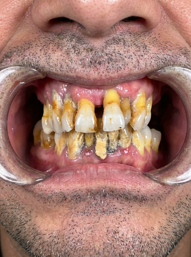 Gum Disease (Periodontitis) Treatment